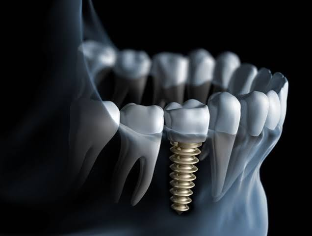 Dental implant and replacement tooth illustration